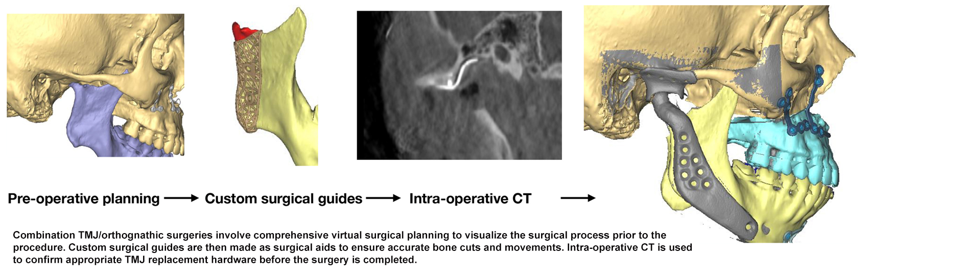 Art demonstrating the process of pre-surgical planning for combination TMJ/orthognathic surgeries.